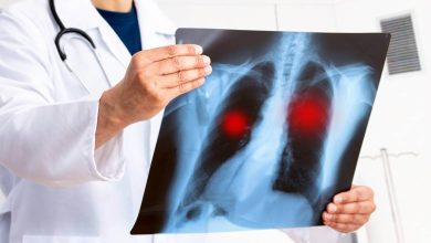 Según cifras del Registro Central de Cáncer, entre el 2018 y 2022 un promedio anual de 759 personas fueron diagnosticadas con cáncer de pulmón